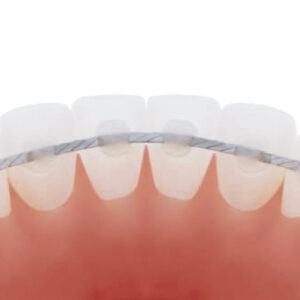 Retenedor fijo dental barra lingual detrás de los dientes ortodoncia