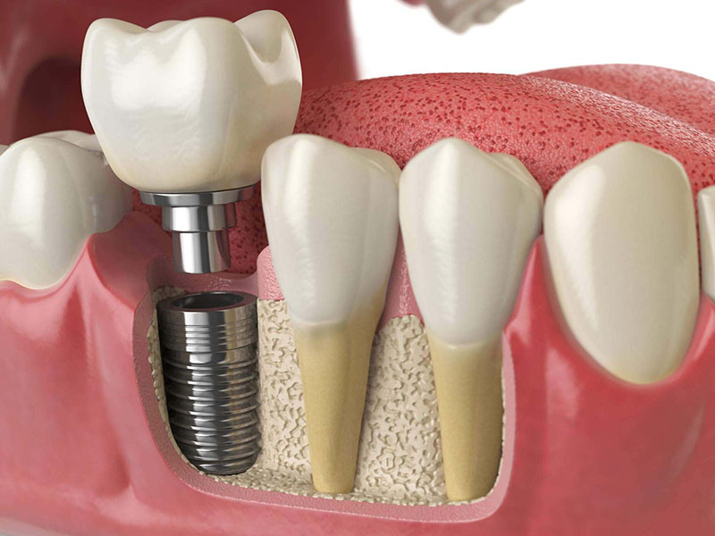 Implantes Dentales