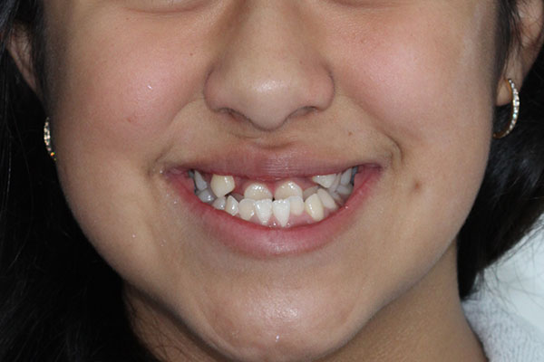 Ortodoncia o Brackets