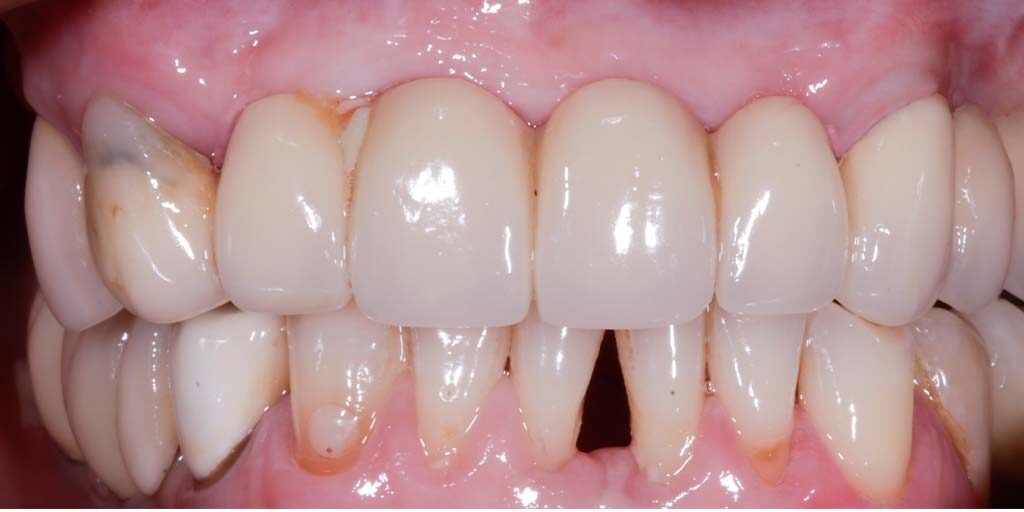 Periodoncia 3 encias sanas antes