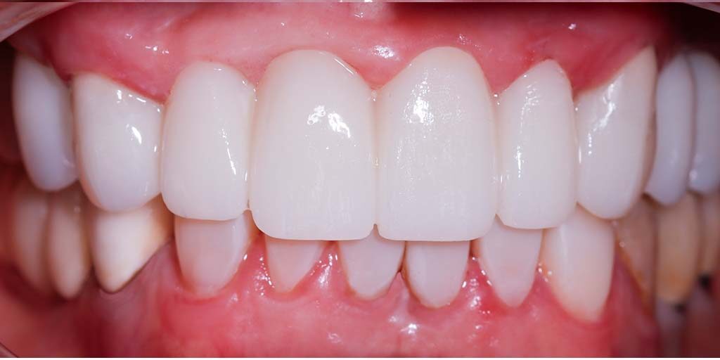 Periodoncia 4 encias sanas despues