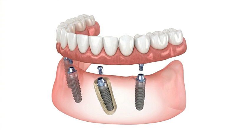Diagrama de técnica All-on-4 para rehabilitación de boca completa