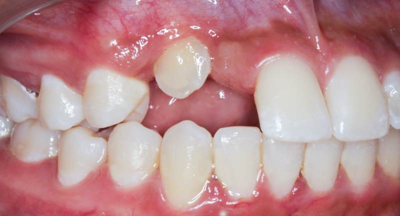 "Caso de éxito de implante dental en Odontología Marlon Becerra