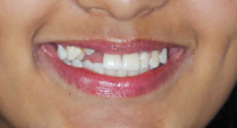 Colocacion del Implante