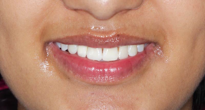 Corona dental definitiva sobre implante osteointegrado