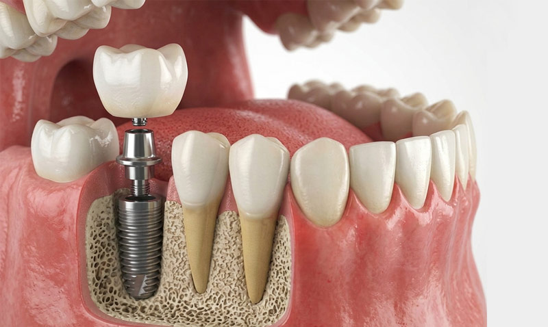 Tecnología de diagnóstico 3D para implantes dentales - Tomografía CBCT