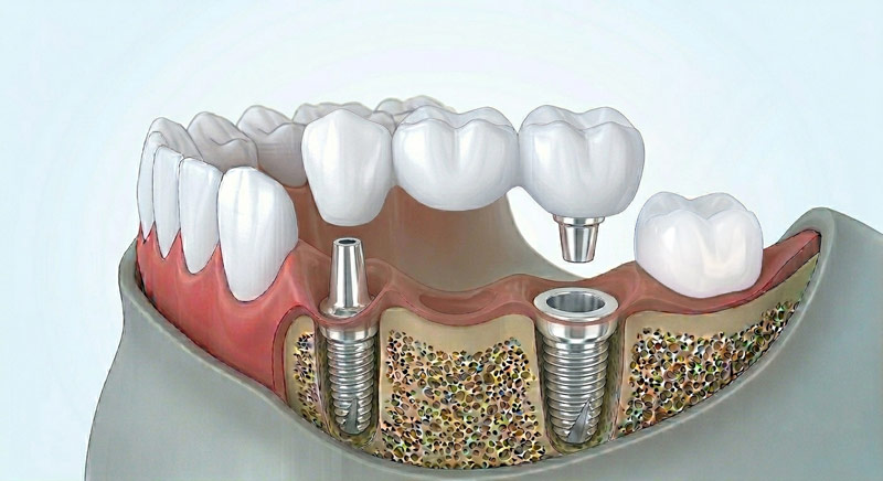 Diagrama de puente dental sobre dos implantes con tres coronas
