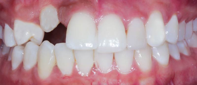 antes de implantes dentales