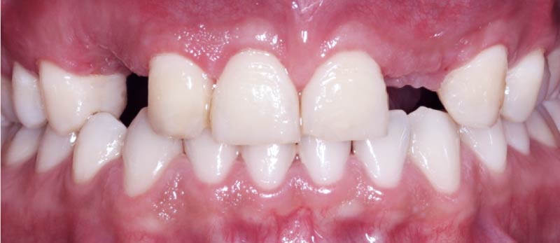 caso antes Implante Unitario Corona