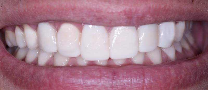 caso despues Implante Unitario Corona