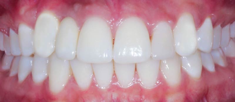 despues de implantes dentales