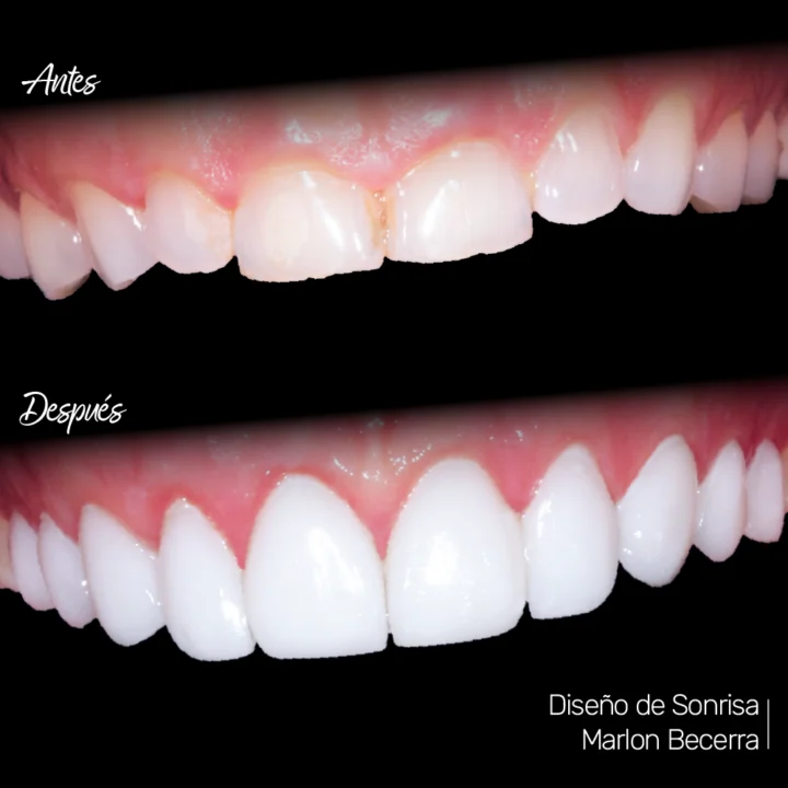 Antes y Despues - Diseño de Sonrisa Antes y Despues - Diseño de Sonrisa